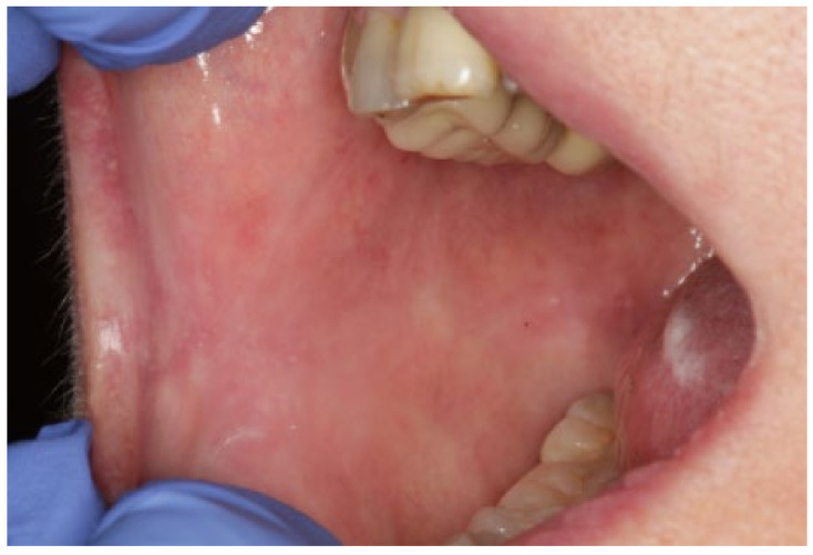 Oral Pemphigoid Recalcitrant Lesion Treated With Prgf Infiltration